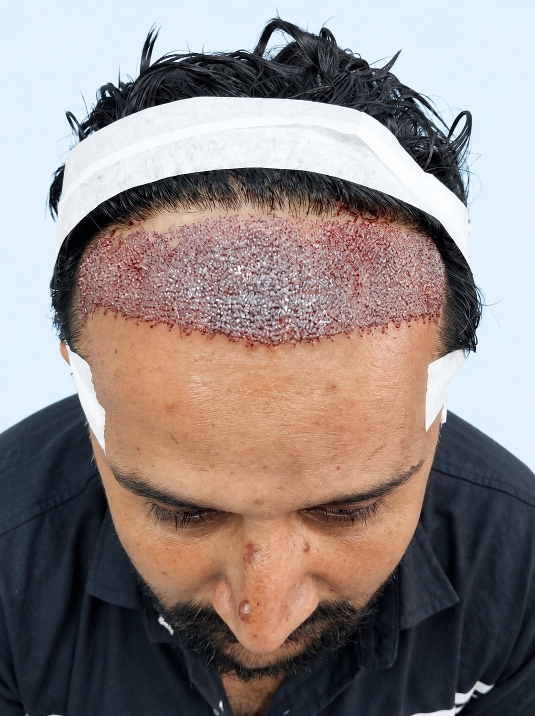 Before hair transplant - crown thinning